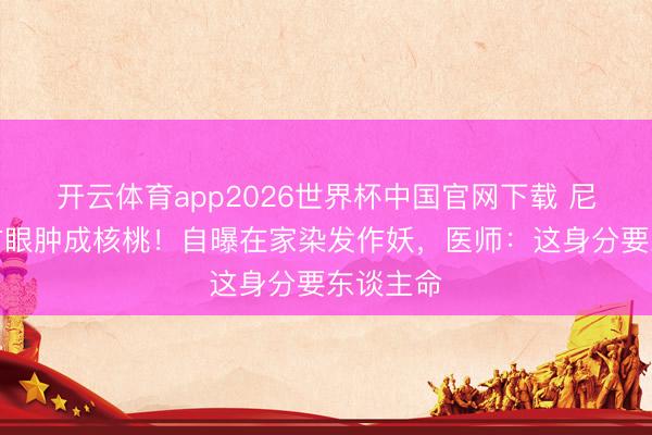 开云体育app2026世界杯中国官网下载 尼格买提右眼肿成核桃！自曝在家染发作妖，医师：这身分要东谈主命